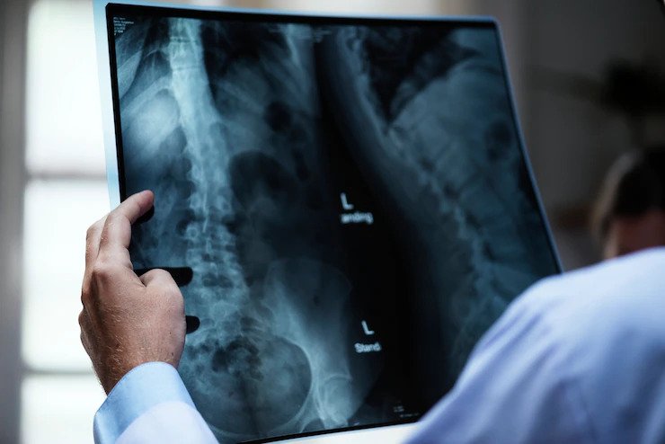 ¿Qué es la fusión espinal tras un accidente de tráfico?