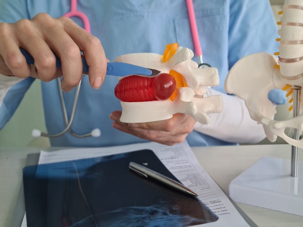 Intervertebral hernia and surgery. Exacerbation of lumbar intervertebral hernia and surgery