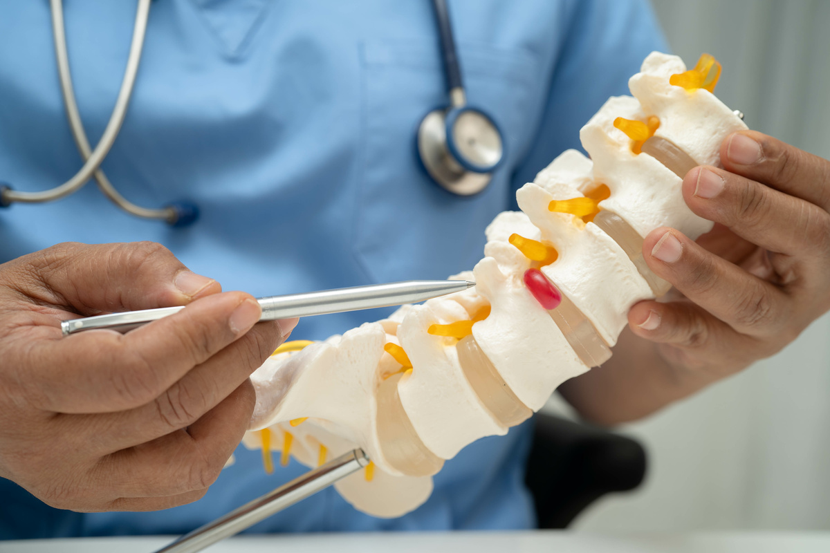 Médico asiático sosteniendo nervio espinal y modelo óseo, columna lumbar desplazada fragmento de hernia de disco para el tratamiento médico en el departamento de ortopedia.