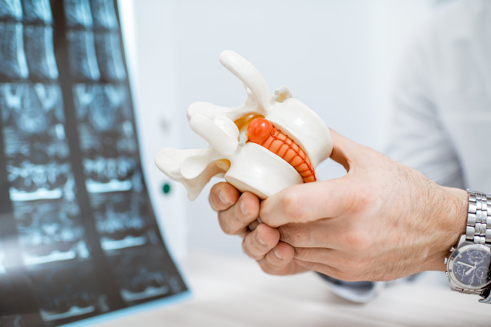 Close-up of therapist holding anatomical model of vertebras with intervertebral hernia