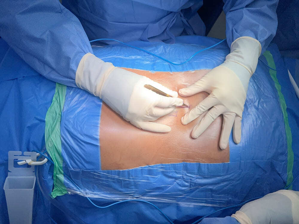 Surgeon performing a minimally invasive spine surgery procedure for back pain treatment in New York