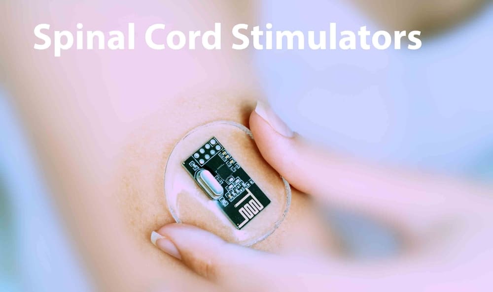 Spinal Cord Stimulator Implant